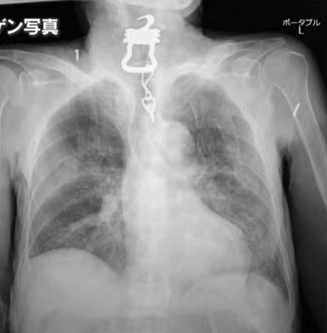 X-ray of the key that was lodged in the elderly man’s throat. Photo: Handout